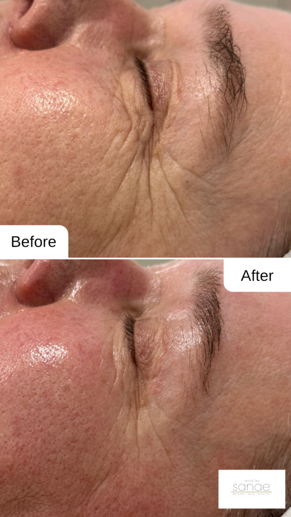 Vorher-Nachher Ergebnis einer FORMA Radiofrequenzbehandlung zur Hautstraffung im Gesicht in Graz