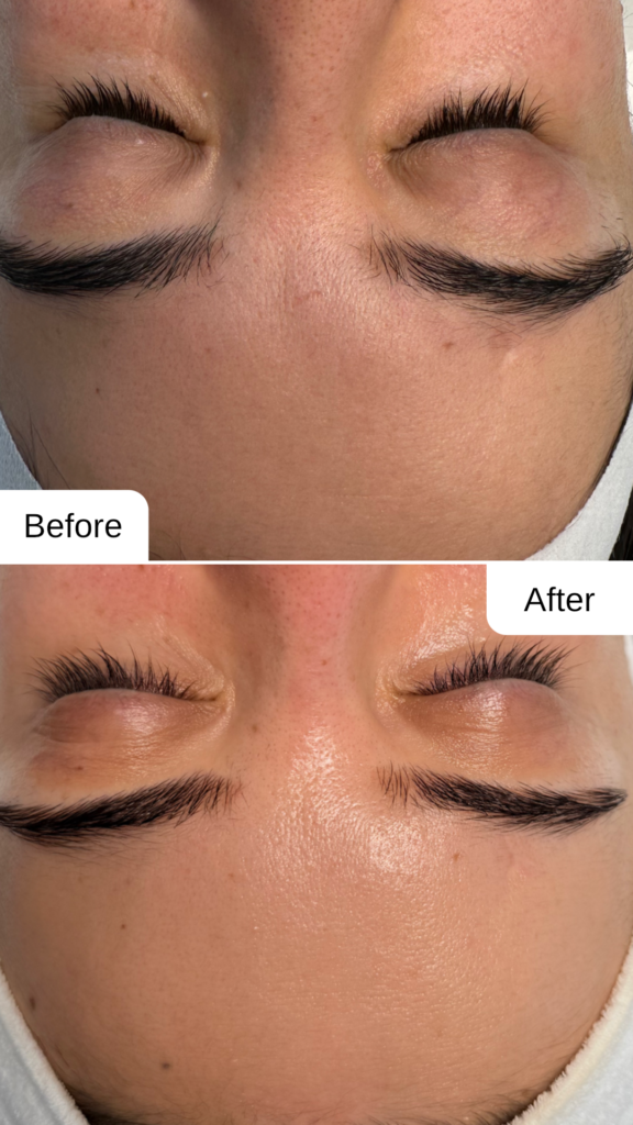 Vorher-Nachher Ergebnis eines Microneedlings im Kosmetikstudio Maison Sanae in Graz mit sichtbar glatterer, strahlender Haut