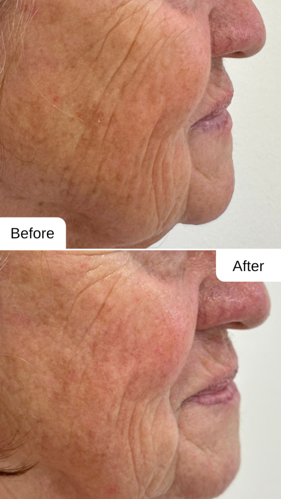 Hautstraffung mit FORMA™ Radiofrequenz – sichtbares Vorher-Nachher Ergebnis in Graz