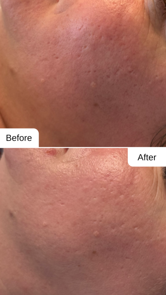 Vorher-Nachher Vergleich nach Microneedling in Graz mit deutlich verfeinerten Poren und verbessertem Hautbild