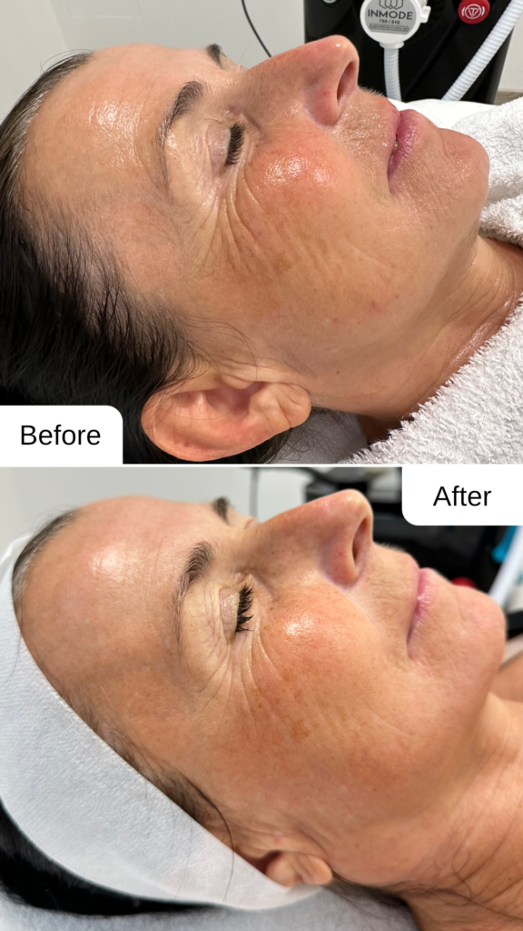 Reduzierung feiner Linien durch FORMA™ Radiofrequenz – Vorher-Nachher Vergleich.