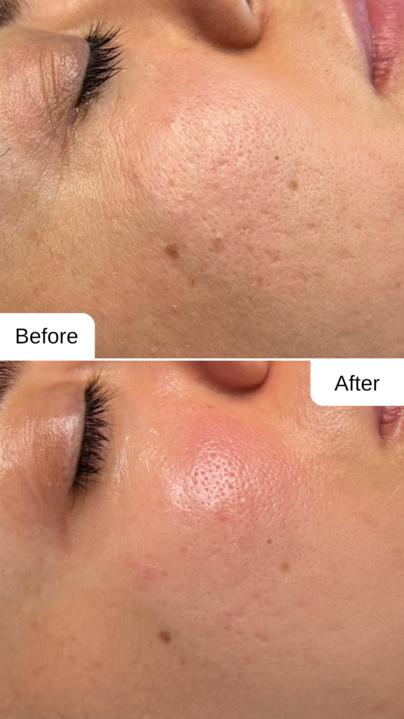 Vorher-Nachher Ergebnis eines Microneedlings zur Reduktion von Aknenarben im Maison Sanae Kosmetikstudio Graz